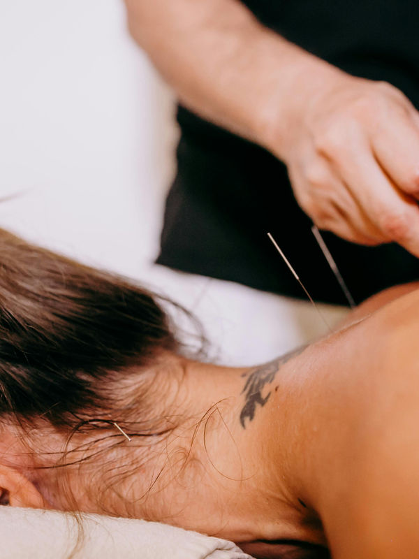 Fine acupuncture needles in place along a patient's neck and upper back