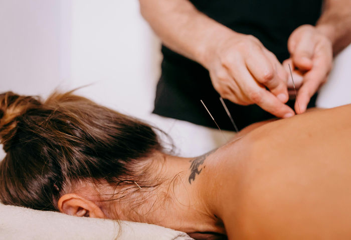 Acupuncture needles being placed along a patient's upper back